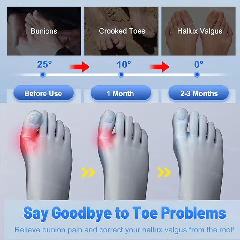 BuneeFix Bunion Corrector